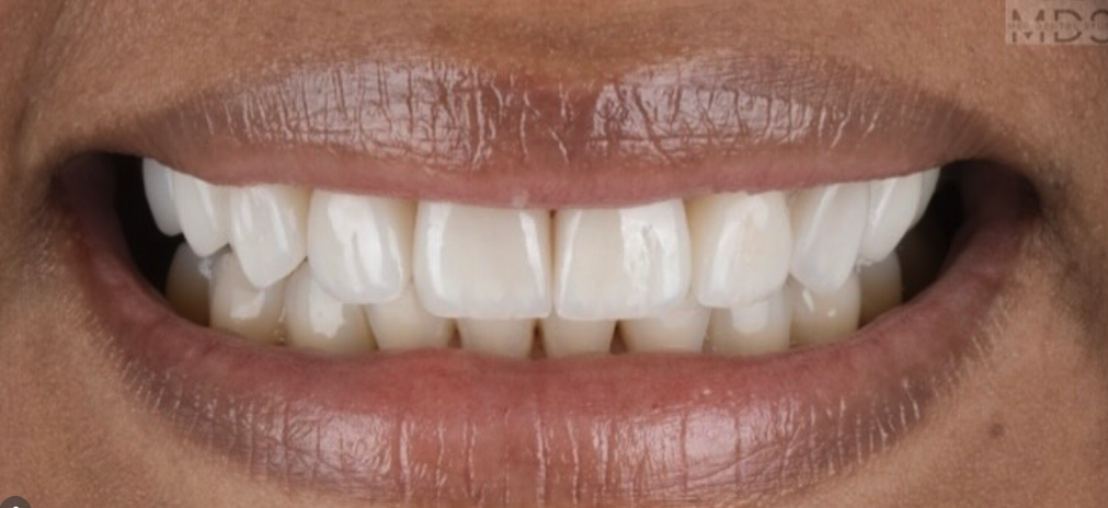 After treatment