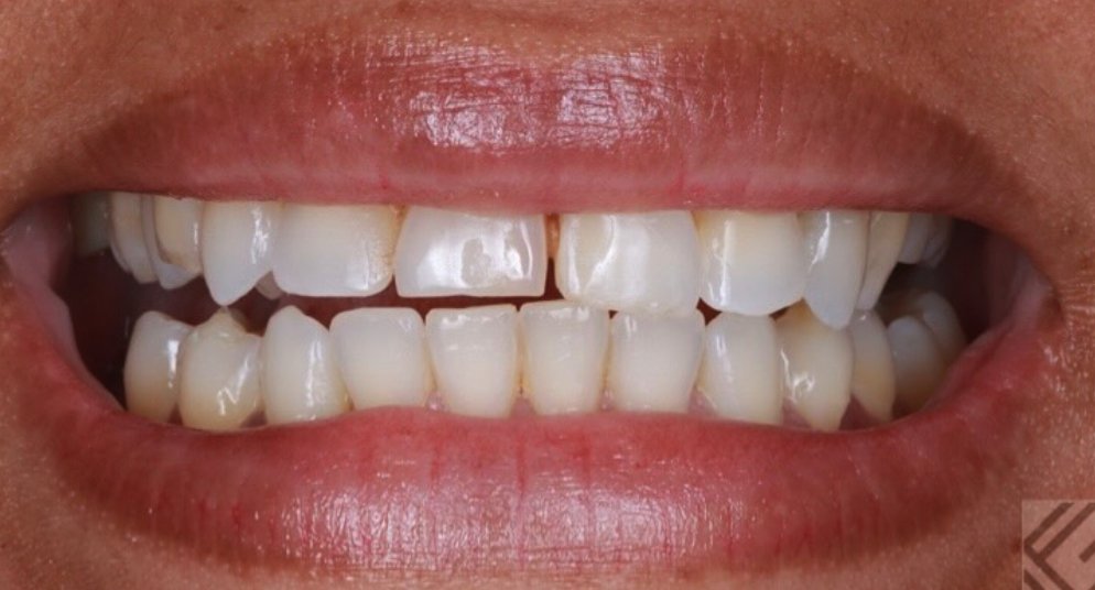 Before treatment